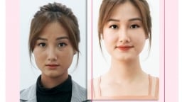 Khám phá công nghệ làm trắng da hiện đại chuẩn y khoa