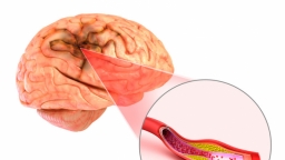 Đột quỵ não và vai trò của chụp cộng hưởng từ (MRI) trong tầm soát đột quỵ