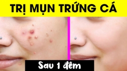 3 mẹo chăm sóc da giúp loại bỏ mụn trứng cá chỉ sau 1 đêm