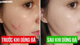 5 cách trị mụn trứng cá tự nhiên cho làn da phục hồi nhanh chóng