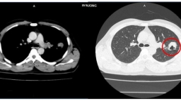 Đi khám vì ho khan, đau tức ngực thì phát hiện ung thư phổi di căn não