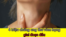 Tưởng bị viêm họng nhưng đi khám phát hiện ung thư vòm họng giai đoạn đầu, 4 dấu hiệu cần lưu ý