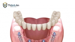 Trồng răng Implant All On 4: Giải pháp phục hồi hàm răng toàn diện, nhanh chóng