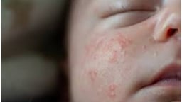 Skinoo Baby Cream – Kem bôi da cho bé đa năng