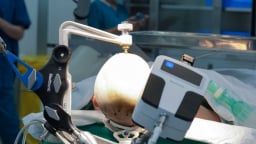 Vinmec tiên phong điều trị động kinh bằng Robot định vị thần kinh hàng đầu thế giới