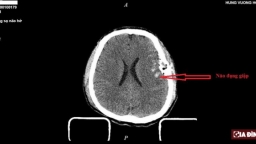 Bị tai nạn giao thông, nam bệnh nhân dập não, vỡ lún xương sọ