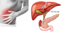 Bữa sáng ăn no, bữa trưa ăn đủ, bữa tối ăn ít để giảm nguy cơ sỏi túi mật