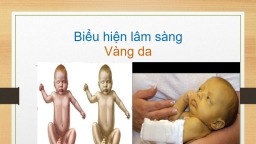 Trẻ bị vàng da, phân bạc màu... có thể là dấu hiệu sớm của bệnh teo đường mật bẩm sinh