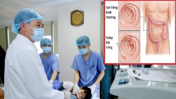 Khoảng 95% ung thư đại tràng phát triển từ polyp đại tràng