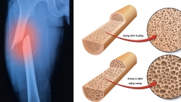 Không phải do di truyền, chế độ ăn uống, đây mới là nguyên nhân hàng đầu gây loãng xương