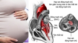 Sản phụ bị bệnh tim kèm theo khối u xơ tử cung nặng 4 kg liều mình sinh con