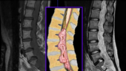 Nữ bệnh nhân đau ê lưng kéo dài, hai chân ngày càng yếu vì căn bệnh hiếm gặp