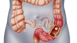 5 dấu hiệu cảnh báo sớm ung thư đại trực tràng: Đi ngoài ra máu, hôm táo hôm lỏng, đau bụng, sụt cân...