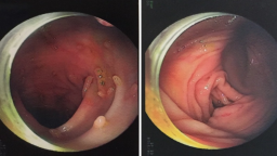 Sau 5 ngày sốt cao, đau bụng, đi khám phát hiện đại trực tràng chằng chịt polyp