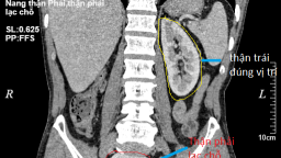Tưởng chỉ có 1 quả thận, bị đau nặng mới biết thận ‘lạc’ chỗ 61 năm
