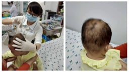 Bé gái bị khỉ cắn lún sọ đã xuất viện
