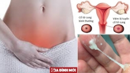 5 căn bệnh thường gặp nhưng dễ gây vô sinh cho phụ nữ