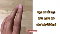 6 đặc điểm cơ thể mà 99% người sở hữu, nhưng bạn có thể là một ngoại lệ