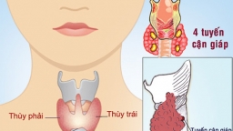 Cảnh báo những biến chứng nguy hiểm gặp phải khi phẫu thuật tuyến giáp