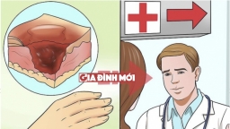 Kỹ năng sơ cứu: Cách sơ cứu khi bị bỏng tại nhà