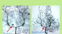 Cứu sống bé gái gần 3 tuổi bị xuất huyết não