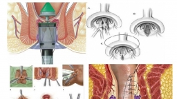 Cách chữa bệnh trĩ bằng phẫu thuật, ưu và nhược điểm cần chú ý