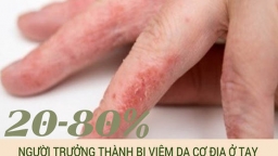 Viêm da cơ địa ở tay: Cảnh báo những biến chứng nguy hiểm cần điều trị ngay