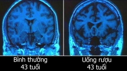 10 thói quen khiến bộ não lão hóa sớm, biết để sửa trước khi quá muộn