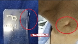 Hóc xương cá dài 2 cm, người đàn ông bị đâm thủng họng