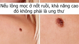 6 dấu hiệu khiến bạn lầm tưởng mình đang bị ung thư