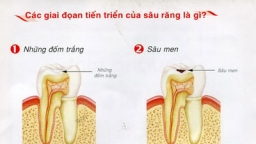 Vì sao đánh răng hàng ngày, răng vẫn bị sâu?