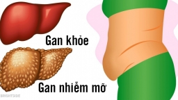 6 dấu hiệu cảnh báo gan đang tích tụ nhiều độc tố