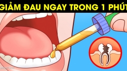 7 cách chữa đau răng sâu tại nhà nhanh nhất không cần thuốc