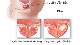 Những thực phẩm làm tăng nguy cơ ung thư tuyến tiền liệt, nam giới nên tránh xa