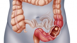 5 cách thải độc đường ruột đơn giản, hiệu quả từ những thực phẩm rẻ tiền