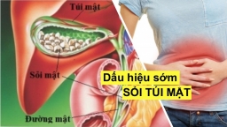 Vì sao phụ nữ hay bị sỏi túi mật? Những dấu hiệu phát hiện sớm sỏi túi mật