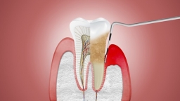 5 tác hại đáng sợ của việc lười đánh răng, không chăm sóc răng miệng đúng cách