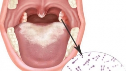 Bệnh bạch hầu có những thể nào? Mắc thể nào dễ gặp biến chứng nguy hiểm?