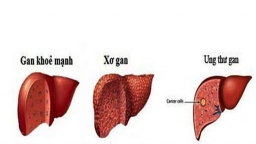 6 thói quen ăn ngủ làm hại gan hơn uống rượu bia, đừng để xơ hóa, ung thư mới biết sợ