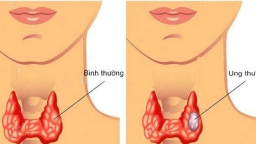 Bị khó nuốt, nuốt nghẹn, người phụ nữ phải cắt toàn bộ tuyến giáp