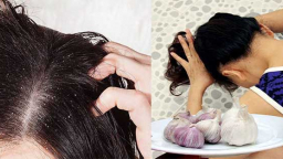 Tổng hợp những cách trị gàu đơn giản mà cực kì hiệu quả tại nhà