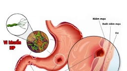 Có phải cứ nhiễm vi khuẩn H.P là bị ung thư dạ dày?