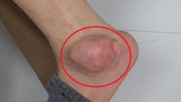 Chữa bệnh gout bằng thuốc trên mạng, người đàn ông bị nổi khối u khủng