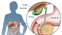 Đau bụng kèm theo sốt và vàng da, người phụ nữ đi viện phát hiện bị teo gan từ lúc nào