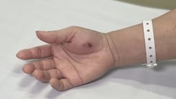 Bị con Cu li cắn vào tay, người phụ nữ ở Hà Nội phải nhập viện do nhiễm độc