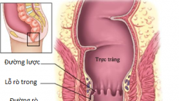 Một người đàn ông đi khám phát hiện 6 lỗ rò quanh hậu môn, hoá ra bệnh này phổ biến sau bệnh trĩ