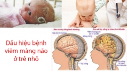 3 biểu hiện thường gặp ở trẻ bị viêm màng não, cha mẹ đừng bỏ qua