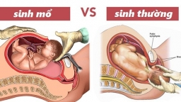 Đẻ thường hay đẻ mổ thì tốt cho cả mẹ và con?