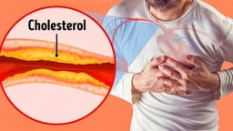 Cholesterol trong máu cao nghĩa là gì? 4 người nguy cơ bị mỡ máu cao