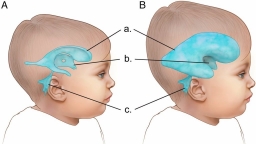 Bệnh não úng thủy là gì? Cách nhận biết sớm trẻ bị não úng thủy